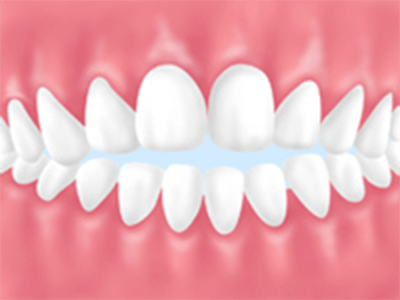 噛んだ時に前歯が開くイメージ